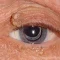 микрохирургия глаза